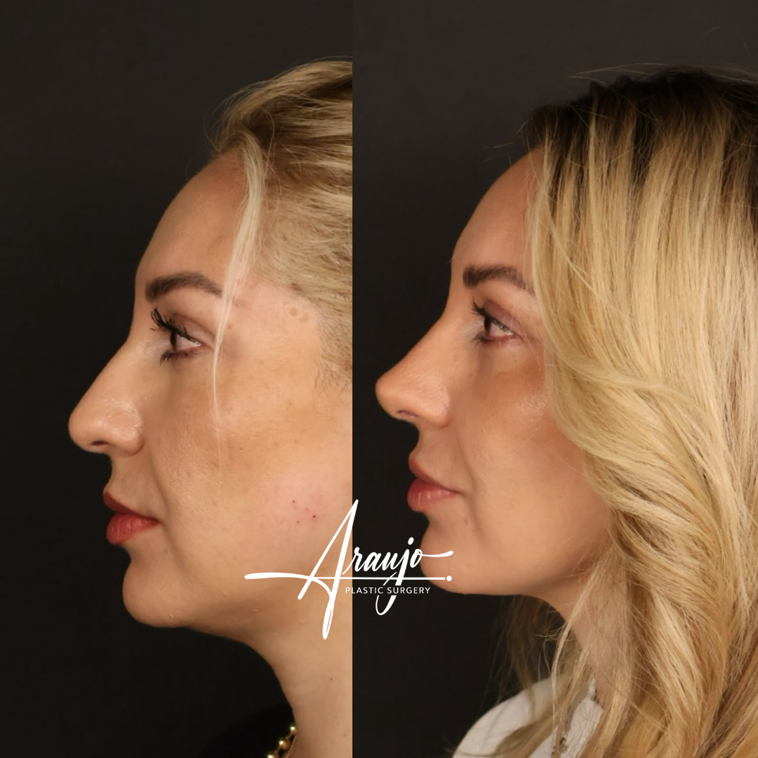 Rinoplastia